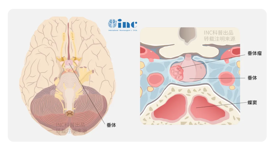 18岁女性停经就诊妇科却转诊神经外科：垂体泌乳素瘤诊疗纪实
