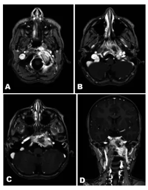 术前MRI，左侧岩骨及斜坡存在强化病灶，注意观察相邻肌肉的受侵情况