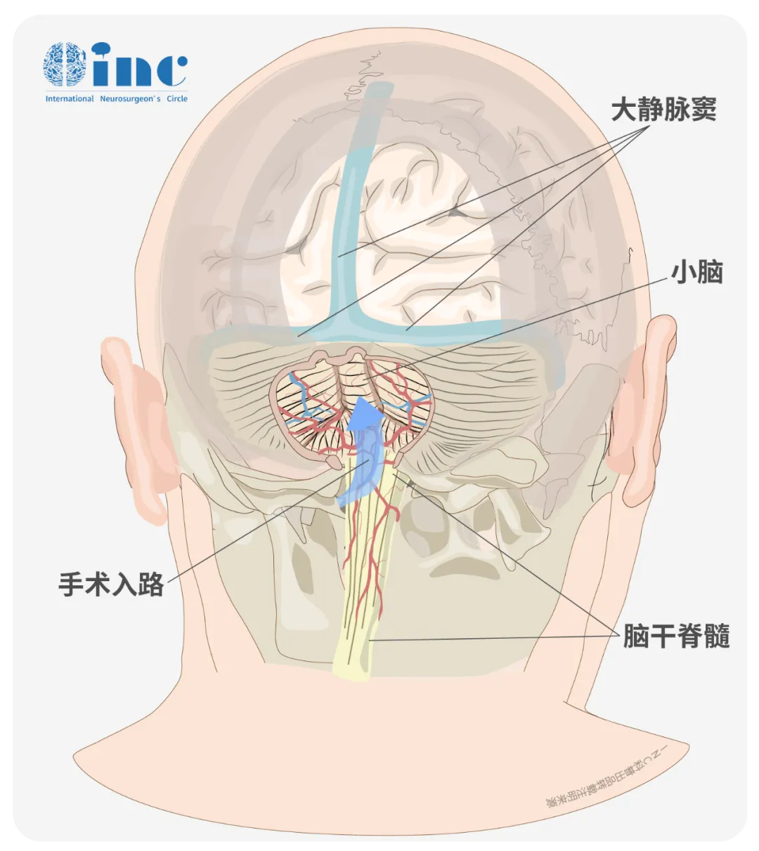 膜帆入路手术解剖的投影。注意枕大孔已经打开，钻孔位于中线两侧。小脑扁桃体、小脑蚓部和半球内侧部分均已显露。有时如果没有预先考虑到，枕窦会导致明显的出血。
