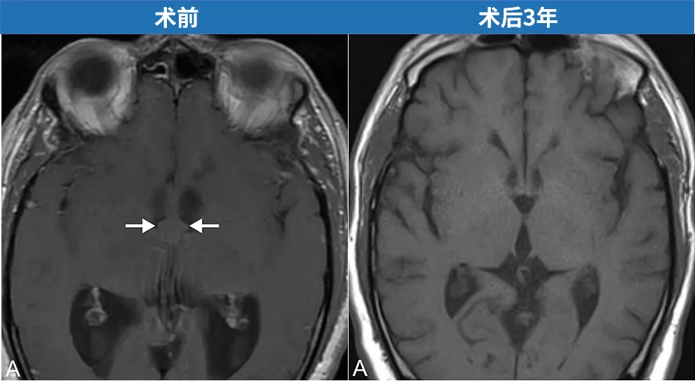 切除大脑里的病变，也不一定要“脑洞大开”。施罗德教授是如何通过神经内镜吸出这个病变的？
