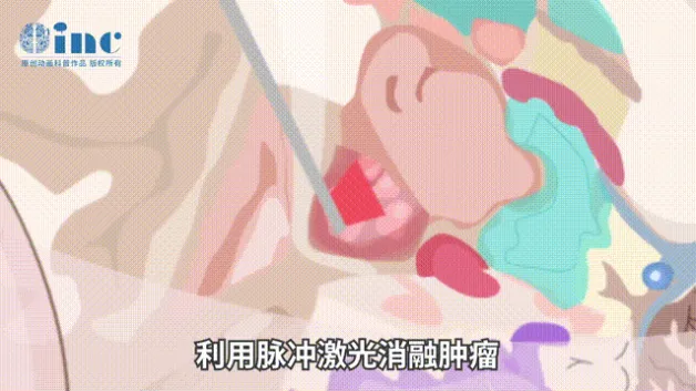 LITT利用脉冲激光消融肿瘤