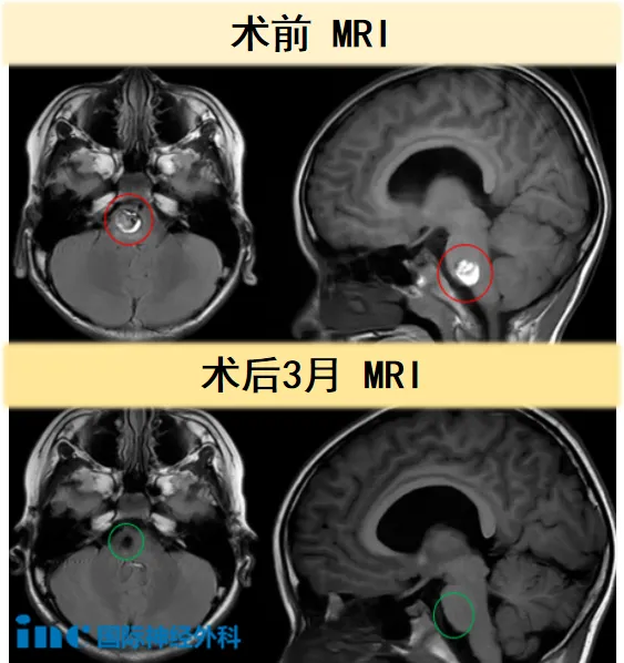 术前和术后3月MRI对比