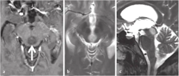 术前MRI