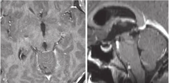 术后MRI