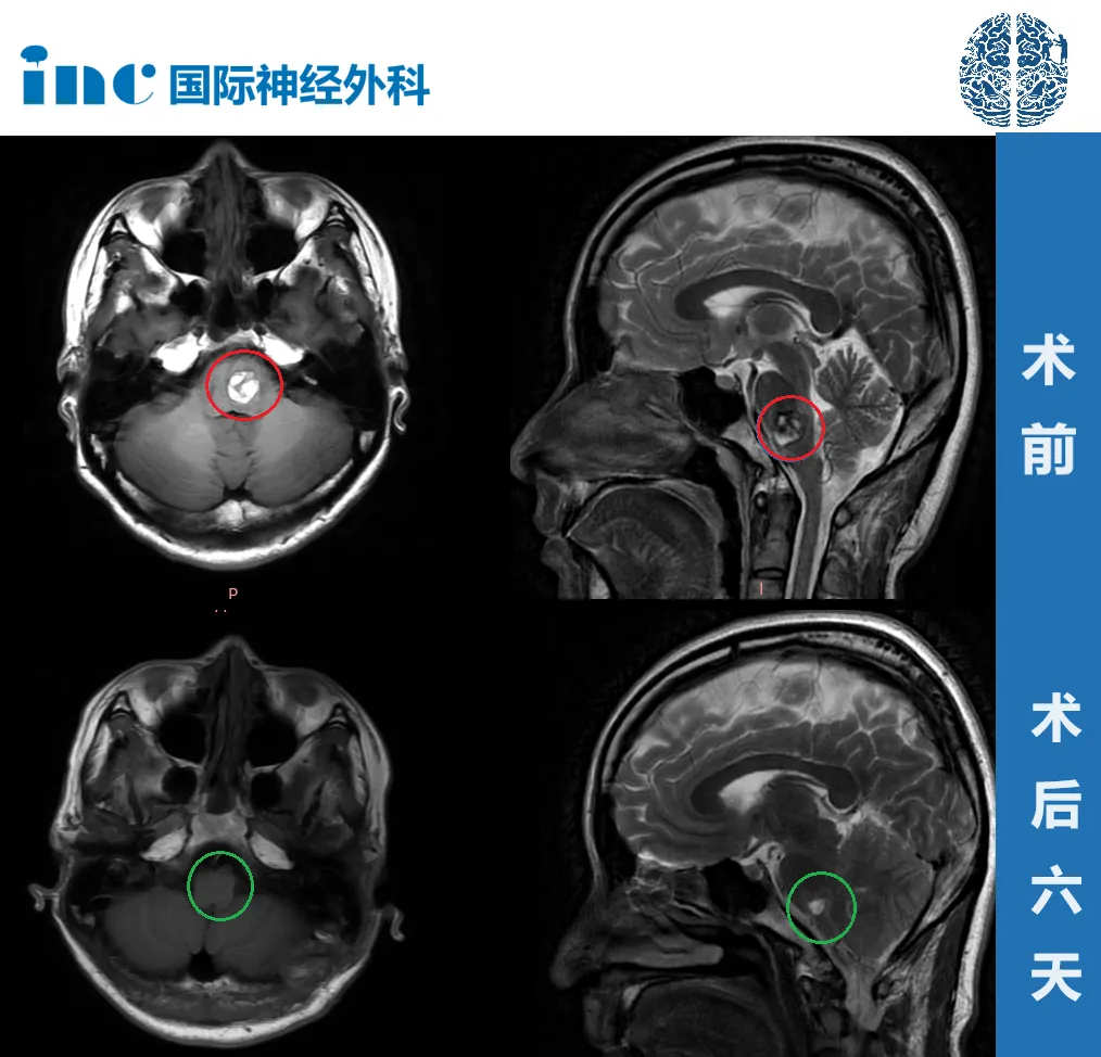 术前术后MRI对比