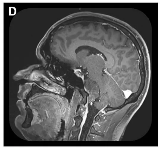 矢状位 MRI 显示肿瘤经栓塞后血供部分阻断（部分去血管化）。