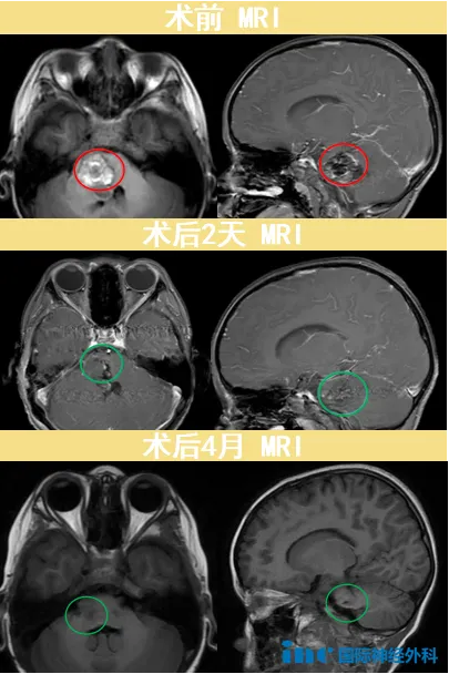 术前术后MRI对比
