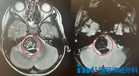 中脑及脑桥出现了新的病灶，巨大的海绵状血管瘤不仅未消，反而合并了大出血。