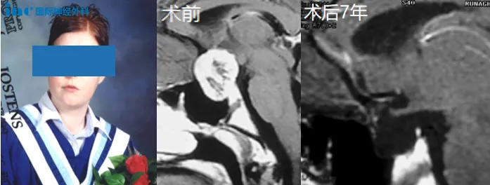 颅咽管瘤折磨她5年，勇敢切瘤后7年未复发、顺利毕业！