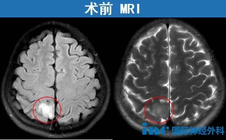术前MRI