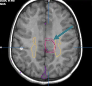 MRI