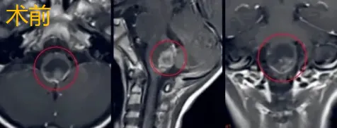术前MRI
