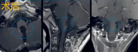 术后MRI