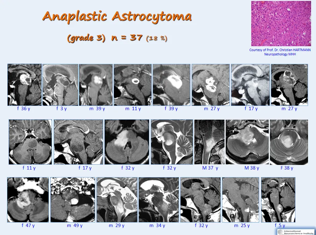 巴教授间变性星形细胞瘤手术系列