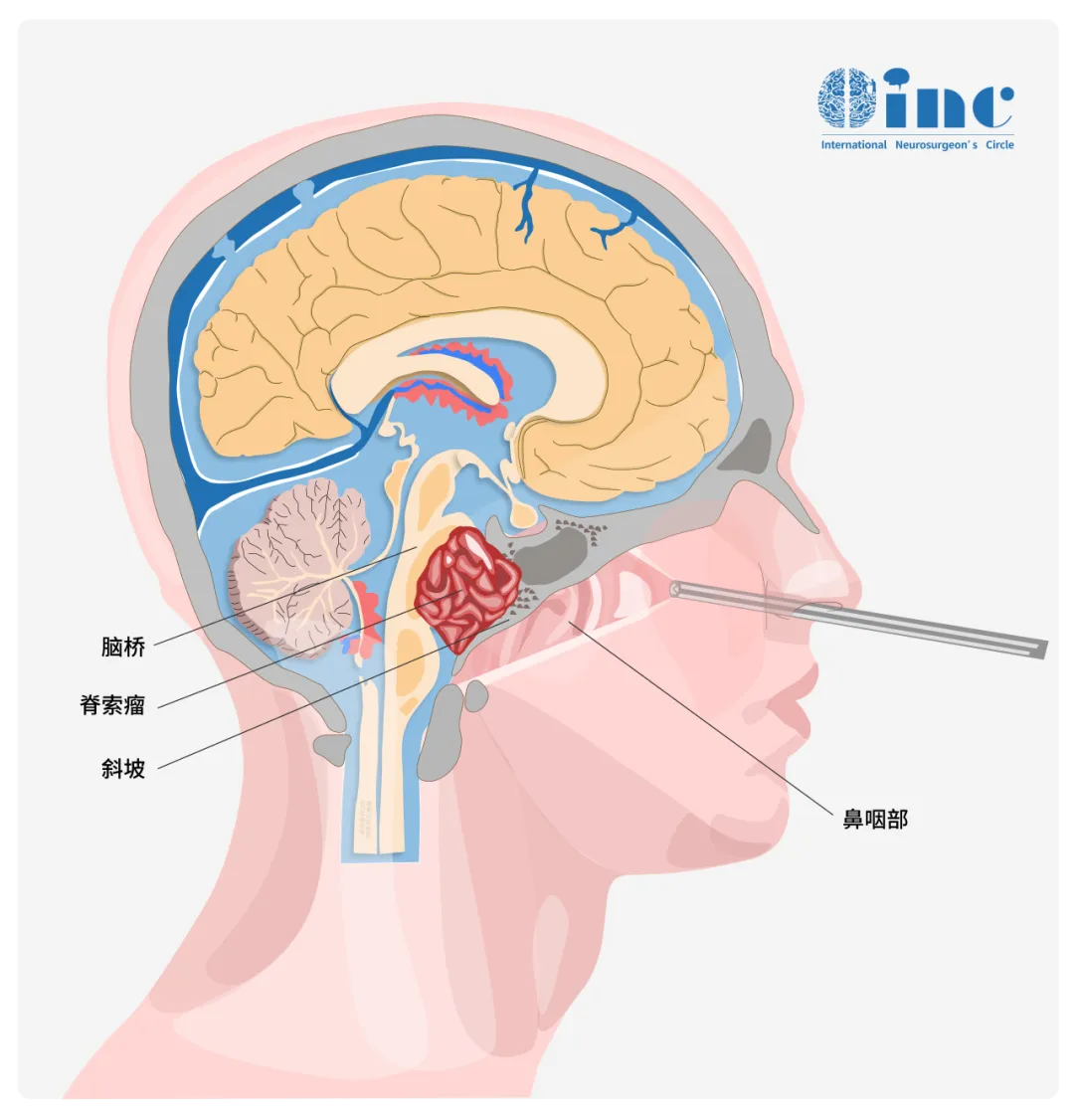 脊索瘤（Chordoma）是一种罕见的恶性肿瘤，通常生长在脊柱或颅底（如斜坡、骶尾部）