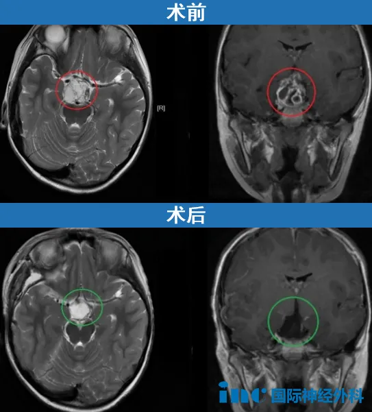 巴教授成功为小迪全切肿瘤，而垂体柄也得到保留