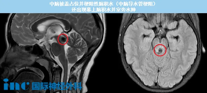 中脑导水管，这个直径仅1-2毫米的细小通道，却承载着维系大脑健康的关键使命，是脑脊液循环的必经之路。