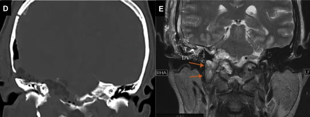 图：(D) 术后CT：示经扩大前岩骨通道直达C1水平。(E) 术后T2加权MRI：肿瘤已全切至颈静脉球及颈内静脉水平；橙色箭头指示肿瘤切除后残腔。