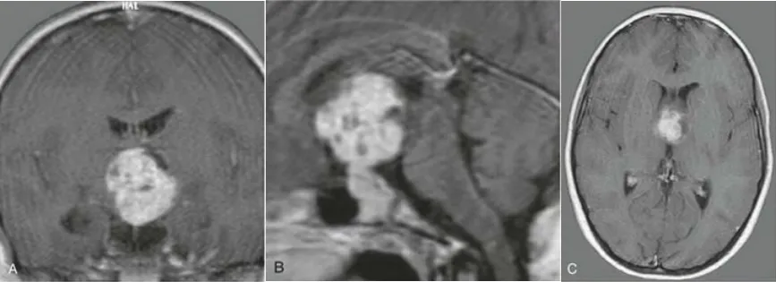 术前MRI（A、B、C）显示第三脑室内富血管实性肿瘤。经右侧联合翼点-眶颧开颅全切除肿瘤，病理证实为颅咽管瘤。