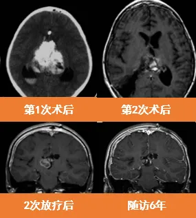 2次手术+2次放疗，成功将这个曾经命悬一线的孩子从死神手里抢了回来，在教授为凯随访的6年时间里，凯一直病情稳定，肿瘤也没有再复发。