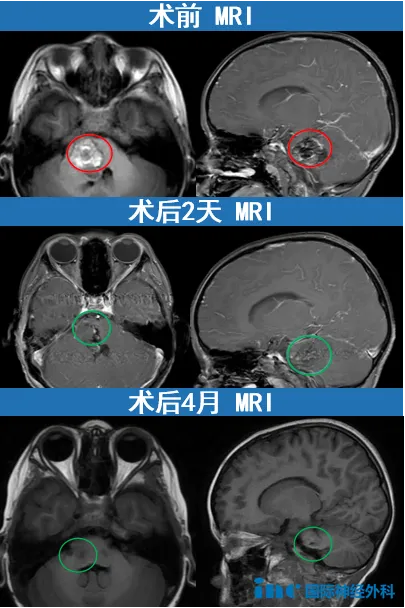 5岁男孩中脑海绵状血管瘤