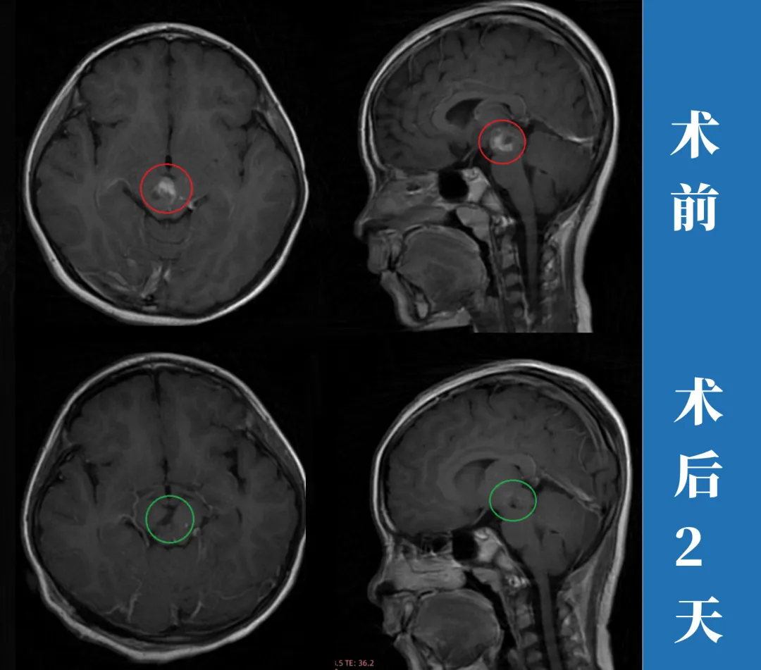 7岁女孩中脑海绵状血管瘤