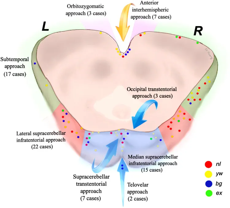 INC巴教授在论文《Microsurgical management of midbrain cavernous malformations: does lesion depth influence the outcome?》中针对精选的76个患者进行分享