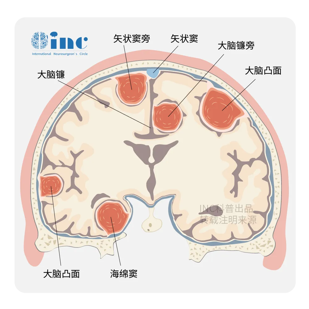 矢状窦旁和大脑镰旁脑膜瘤至少侵犯或触及上矢状窦（SSS）。由于其位置靠近SSS、相关桥静脉以及紧密接近大脑功能区，因此没有永久性神经缺损的根治性手术可能很难实现。
