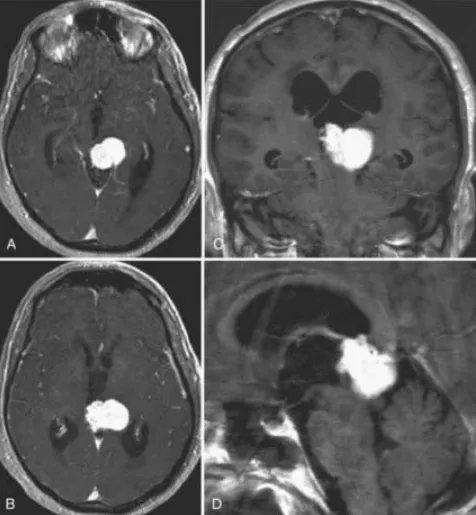 术前MRI