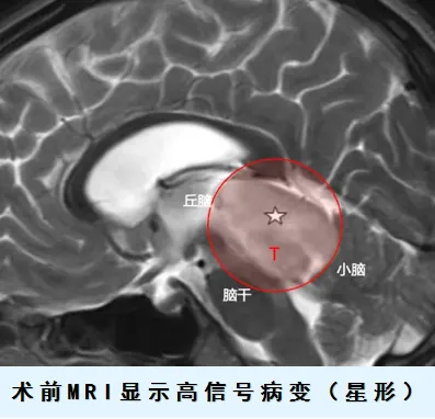 术前MRI显示高信号病变（星形）