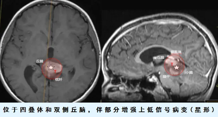 位于四叠体和双侧丘脑，伴部分增强上低信号病变（星形）