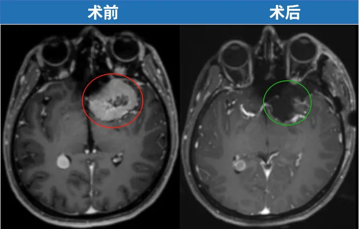 以精湛技艺重新校准生命的轨迹，既将肿瘤完整切除，又守护住了每一处关键神经功能