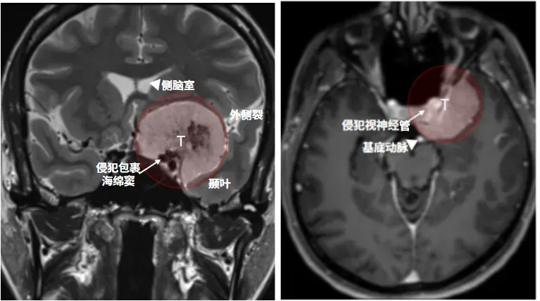 那颗肿瘤已经像八爪鱼一样紧紧缠住颈内动脉，压迫视神经