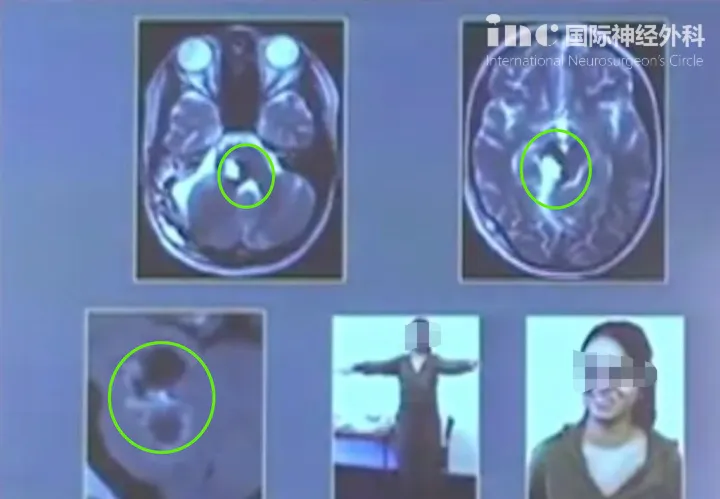 无新发神经功能损伤，术前症状明显改善，肢体瘫痪、面瘫好转，能自行行走，治疗效果满意。术后5年随访，无复发，我们可以看到图片中的女孩已经站了起来。