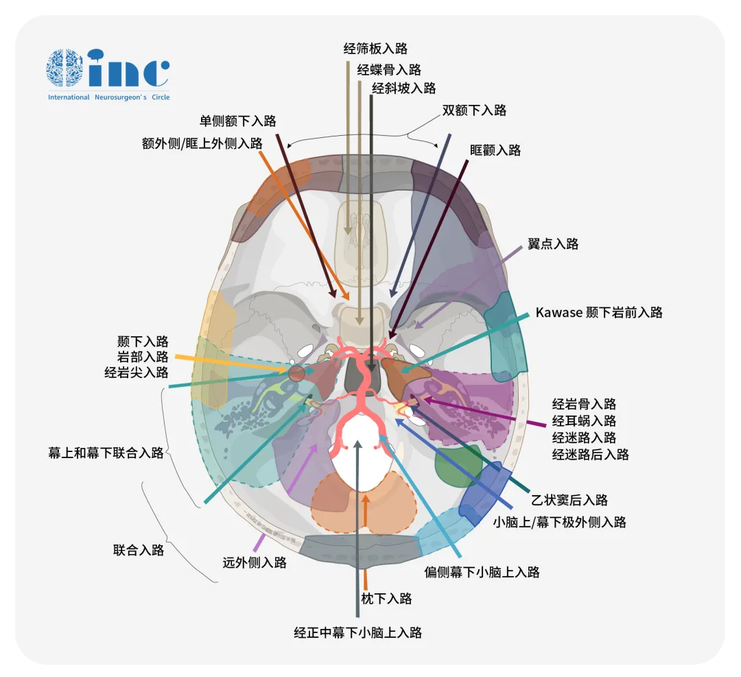 川岛教授采用颞下入路实施STA-PCA搭桥手术来治疗，而另有学者提出小脑上幕下极外侧入路（ILSA）实施枕动脉（OA）-PCA搭桥手术