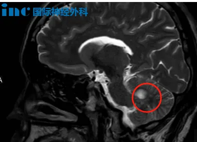 病变竟同时潜伏在两个危险的位置——掌管平衡协调的小脑，以及被称为“生命中枢”的脑干