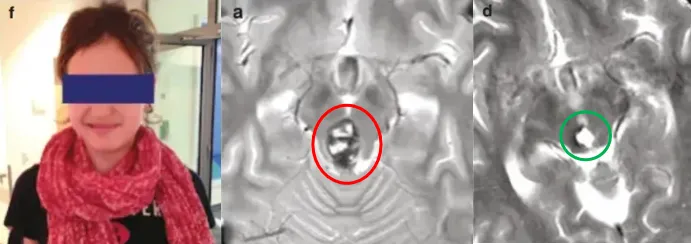 手术正式开始，这是一场与死神的争夺赛，而结果却出乎所有人意料——手术全切脑海绵状血管瘤，喜喜术后无任何并发症，顺利出院后她笑容如初！