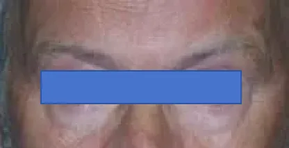 术后6个月随访时，Keith右侧眉毛区域的瘢痕几乎不可见，证明眉弓切口的美容效果极佳。