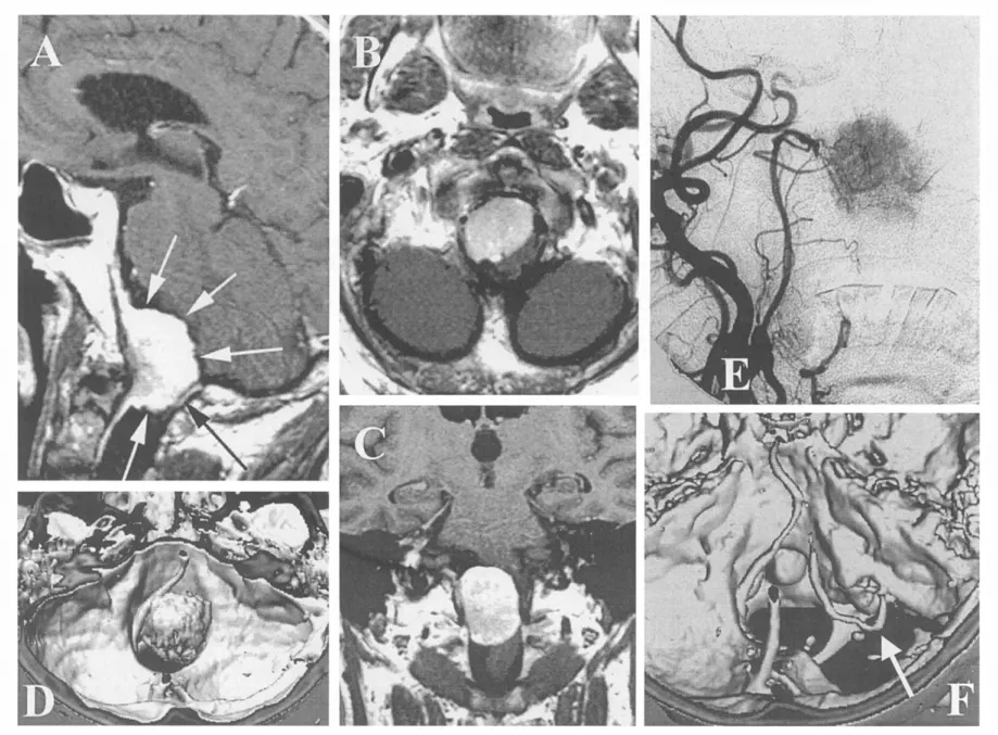 59岁男性枕骨大孔区巨大脑膜瘤案例  (A–C) 术前MRI。  (D) 三维增强CT示肿瘤以宽基底附着于枕骨大孔前缘中线两侧，占据大孔腔隙超过2/3；右侧椎动脉被肿瘤包绕。  (E) 血管造影显示肿瘤主要由咽升动脉分支供血。  (F) 术后三维CT示经小型背外侧颅骨切除并磨除枕骨大孔外侧缘后，肿瘤已全切；右侧椎动脉及寰椎后弓得以保留；箭头示椎动脉水平段后袢。术后恢复平稳，无并发症。