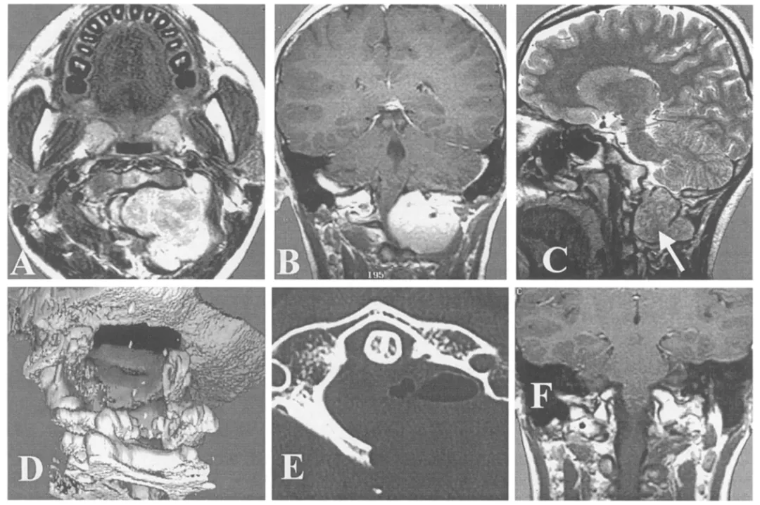 13 岁男孩 C1–2 节段左侧巨大硬膜内-外神经鞘瘤案例  (A-C) 术前MRI(D) 术后三维CT 重建； (E) 寰椎轴位 CT 示左侧半椎板切除（hemilaminectomy）；  (F) 肿瘤全切，术后 MRI 未见肿瘤残留，术后未出现新的神经功能缺损。