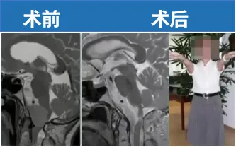 75岁女性，出现共济失调、颈部疼痛。顺利全切后，失衡消失，无神经功能损伤，生活恢复正常。