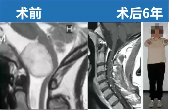 33岁女性，颈部剧烈疼痛、身体右侧感觉异常。顺利全切，术后6年未复发，状态良好。无神经功能损伤。