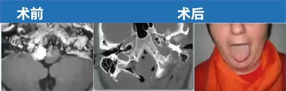 51岁女性，出现眩晕，轻微舌下神经功能障碍。顺利全切后，舌下神经功能障碍消失。