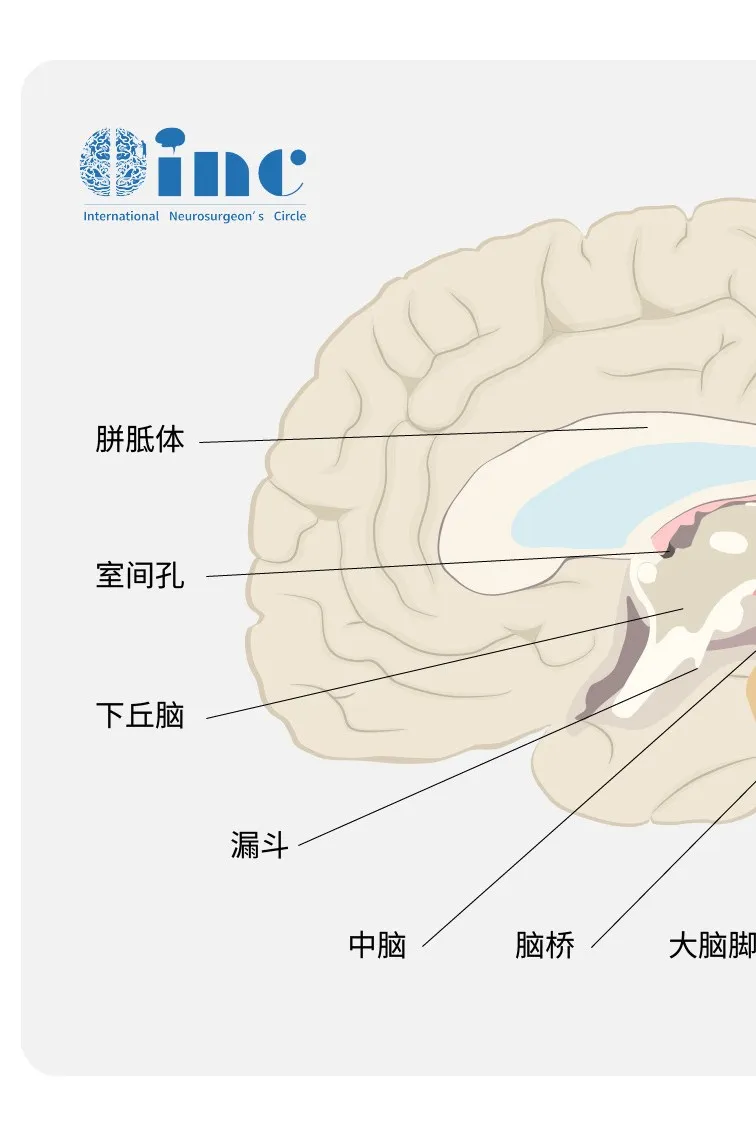 颅内畸胎瘤是颅内生殖细胞瘤中的一种亚型，是由一个以上胚叶多种组织构成的一种先天性肿瘤，常见于松果体区或第三、四脑室。