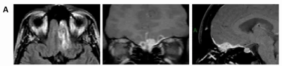 头颅 CT 及 MRI 显示：嗅沟区占位病变，向右筛板延伸，并伴额-嗅区双侧硬脑膜增强