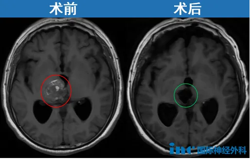 江先生因右侧丘脑、中脑及桥脑海绵状血管瘤突发出血，病情危急：持续头痛、视物模糊、肢体麻木疼痛无力、不能行走，一家人将他从河北120紧急转运到苏州。从咨询巴教授到手术顺利完成，仅用了短短3天时间。