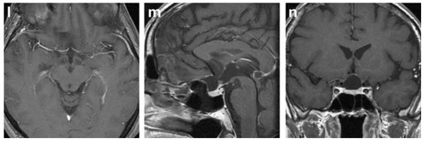 术后39个月增强T1加权MRI，均未见肿瘤残留或复发