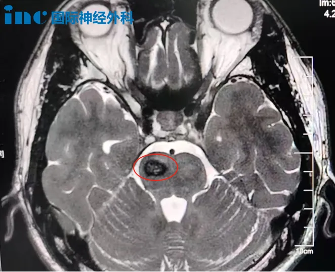 在脑干海绵状血管瘤还处于萌芽阶段时，就被及时发现并交由巴教授完成精准切除，消除了再次出血的风险