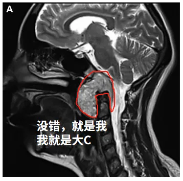 这一次我要在颅颈交界区（CVJ）搞事情——这里可是连接大脑和颈椎的“战略要地”！