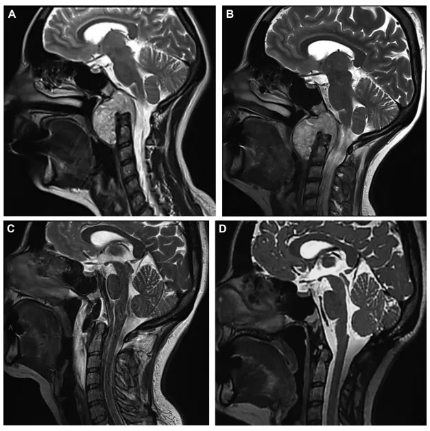 图示：MRI 显示一例颅颈交界区（CVJ）脊索瘤，其术前肿瘤生长速率（TGR）较低（3.53%/月）。 A：手术前 3 个月； B：术前 1 天； C：术后 48 小时，提示肿瘤全切除（GTR）； D：术后 14 个月（术后已行质子放疗 PBT），未见肿瘤复发。
